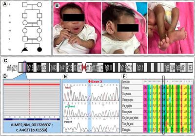 Case Report: Mutation in AIMP2/P38, the Scaffold for the Multi-Trna Synthetase Complex, and Association With Progressive Neurodevelopmental Disorders